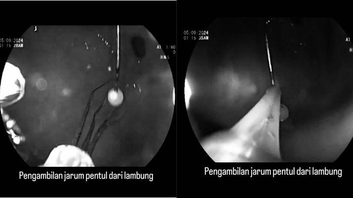 Viral Dokter Berhasil Keluarkan Jarum Pentul Tertelan Hijabers dari Lambung Tanpa Operas